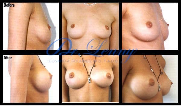 Breast Augmentation before and after, Case 10