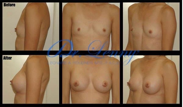 Breast Augmentation before and after, Case 12