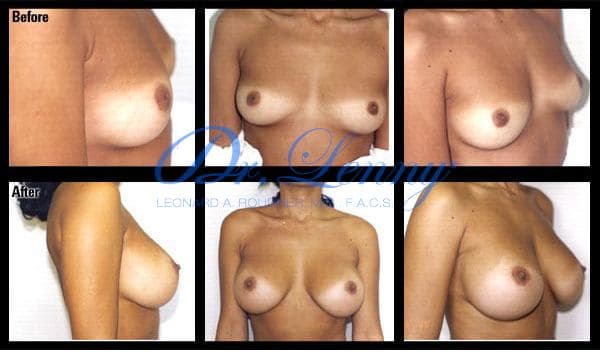 Breast Augmentation before and after, Case 18