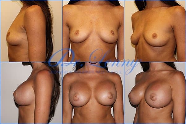 Breast Augmentation before and after, Case 21