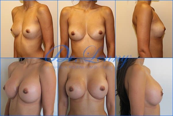 Breast Augmentation before and after, Case 03