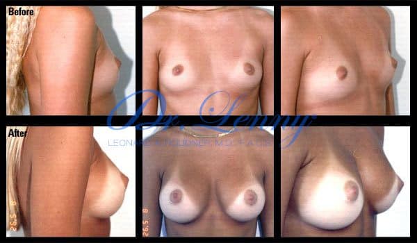 Breast Augmentation before and after, Case 04