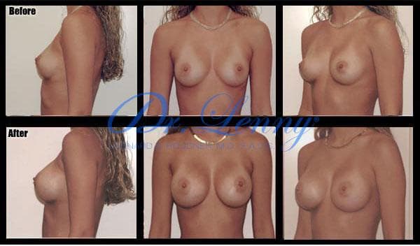 Breast Augmentation before and after, Case 06