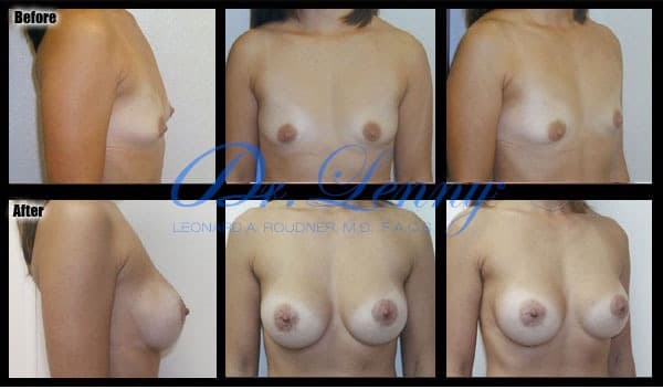 Breast Augmentation before and after, Case 07