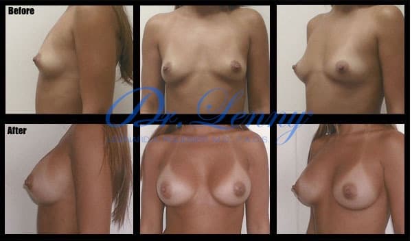 Breast Augmentation before and after, Case 08